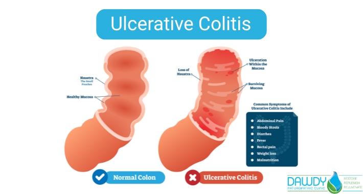 Ulcerative Rash How Can a Naturopathic Doctor Help With Ulcerative Colitis? | Dawdy ...